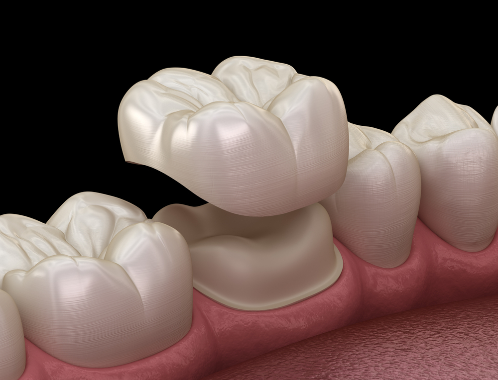 Dental crown placement illustration showing a dental crown being positioned over a tooth, emphasizing restorative dentistry and dental health.